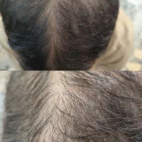 آف تخلیه غبغب وپی ارپی