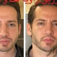 تزریق چربی به صورت وساکشن شکم وپهلو|خدمات آرایشگری و زیبایی|نهاوند, |دیوار