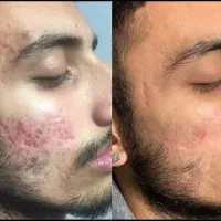 درمان تخصصی اسکار صورت