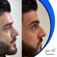 جراحی بینی با قیمت استثنایی|خدمات آرایشگری و زیبایی|بروجرد, |دیوار