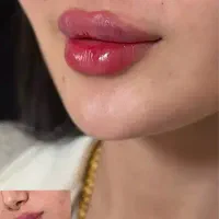 تخفیفات تزریق ژل و بوتاکس کلینیک زیبایی