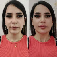 تزریق ژللب ،گونه،زاویه فک و چانه و بوتاکس،مادلینگ|خدمات آرایشگری و زیبایی|اصفهان, رکن الدوله شرقی|دیوار