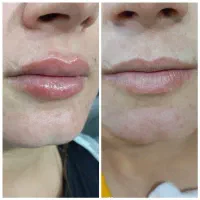 خدمات ژل وبوتاکس