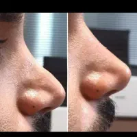 ژل فیلر بوتاکس و پی ارپی