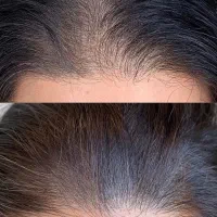 کلینیک تخصصی پوست ومو «پی آر پی،اگزوزوم،مزوتراپی»|خدمات آرایشگری و زیبایی|شیراز, عفیف‌آباد|دیوار