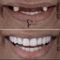 وام دندانپزشکی ایمپلنت|خدمات آرایشگری و زیبایی|رباط‌کریم, رباط‌کریم|دیوار