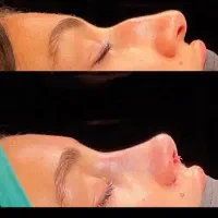 جراحی بینی/۲۷میلیون/کلینیک ومشاوره رایگان