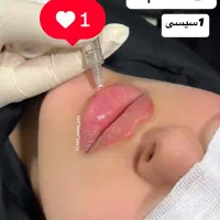 ژل وبوتاکس|خدمات آرایشگری و زیبایی|اهواز, کمپلو شمالی|دیوار