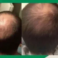 همین حالا یه درمان ریشه‌ای روبرای موهات استارت بزن