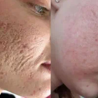 پاکسازی تخصصی پوست با دستگاه|خدمات آرایشگری و زیبایی|لاهیجان, امیرشهید|دیوار