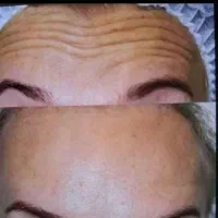 ، تزریق ژل فیلر بوتاکس مزو فیلر بادی..|خدمات آرایشگری و زیبایی|شیراز, فضل‌آباد|دیوار