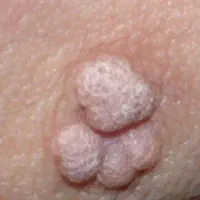 درمان زیگیل و خال