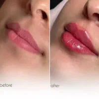 تزریق چربی،ژل،بوتاکس ونخ و مادلینگ تخصصی توسط پزشک|خدمات آرایشگری و زیبایی|کرمانشاه, |دیوار