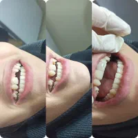 جایگزین ایمپلنت|خدمات آرایشگری و زیبایی|یزدان شهر, |دیوار