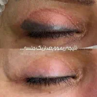 لـیزر موهای زائد/الکساندرایت/پی ار پی/پاککردن تاتو|خدمات آرایشگری و زیبایی|مشهد, آزادشهر|دیوار