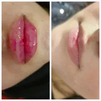 ژل بوتاکس بلفارو پلاستی لیزر|خدمات آرایشگری و زیبایی|اهواز, اهواز|دیوار