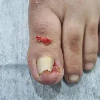 درمان پیشرفته اسیب های ناخن