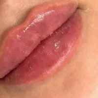 تزریق ژل و بوتاکس،جوانسازی .برای آقایان و خانمها