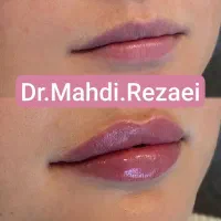 60%تخفیف لیفت صورت.وانجام لیفت بایشترین تعدادنخ|خدمات آرایشگری و زیبایی|مشهد, نیروی هوایی|دیوار