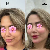 تخفیف ژل بوتاکس مزو آنزیم فیلر غبغب پی ارپی|خدمات آرایشگری و زیبایی|اصفهان, وحید|دیوار
