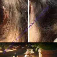 درمان ریزش مو و رویش مجدد با روغن اکسیر دوگانه