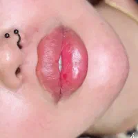 تزریق فیلر باتخفیف۳۰درصدی۷۹۹بوتاکس۱۲۰۰