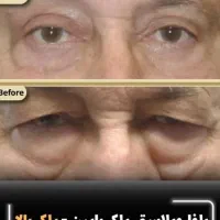 بلفاروبلاستی/کاشت مو/کاشت ابرو/کاشت ریش/عمل بینی|خدمات آرایشگری و زیبایی|همدان, |دیوار