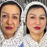 لیفت و جوانسازی صورت با ارزان ترین قیمت توسط پزشک|خدمات آرایشگری و زیبایی|مشهد, هنرستان|دیوار