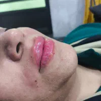 مدل ژل وبوتاکس|خدمات آرایشگری و زیبایی|اهواز, فاز ۲ پادادشهر|دیوار