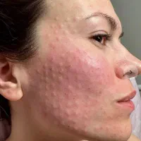 جشنواره تخفیف بوتاکس و‌مزوژل