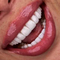 دندان مصنوعی تحویل( ۵ساعته)،کامپوزیت دندان ، روکش|خدمات آرایشگری و زیبایی|تهران, میدان ولیعصر|دیوار