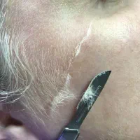 اصلاح درماپلینگ