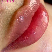 تزریقات ژل‌ لب زاویه فک و بوتاکس با بهترین متریال|خدمات آرایشگری و زیبایی|مشهد, توس (بلوار توس)|دیوار