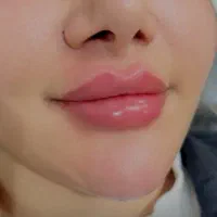 ژل و بوتاکس