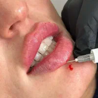 مدل برای فیلر لب ،صورت و بوتاکس
