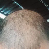 درمان قطعی ریزش مو و رویش مجدد