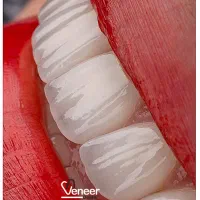 دندانپزشکی کامپوزیت ایمپلنت لمینت (بدون تراش)|خدمات آرایشگری و زیبایی|تهران, زعفرانیه|دیوار