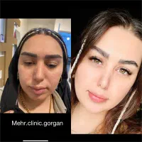 ده سال جوانتر شو با هایفو تراپی
