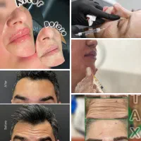 دعوت از خانم های دانشجو برای فیلروبوتاکس رایگان