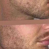 ژل و بوتاکس|خدمات آرایشگری و زیبایی|بم, |دیوار