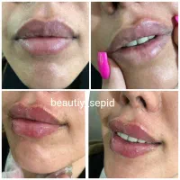 ژل و بوتاکس|خدمات آرایشگری و زیبایی|شیراز, دوکوهک|دیوار