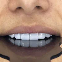 کامپوزیت زیبایی دندان