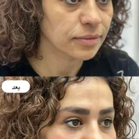 تخفیفات ژل و بوتاکس کلینیک آقایان و خانم ها تا|خدمات آرایشگری و زیبایی|شاهین‌شهر, فردوسی|دیوار