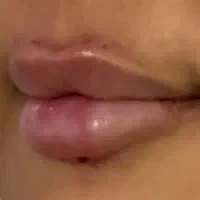 مدل ژل لب گونه چونه بوتاکس|خدمات آرایشگری و زیبایی|اسلام‌شهر, مطهری|دیوار
