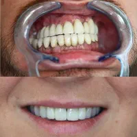 قسطی ایمپلنت و تمام خدمات دندانپزشکی بدون پیش|خدمات آرایشگری و زیبایی|اصفهان, دشتستان|دیوار