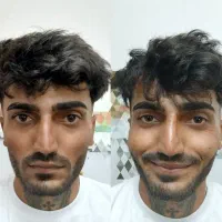 تزریق ژل و بوتاکس به صورت تخصصی