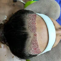 جشنواره کاشت مو ابرو شقیقه و ریش|خدمات آرایشگری و زیبایی|قم, سالاریه|دیوار