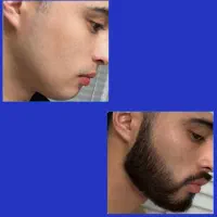 رویش ریش و سیبیل