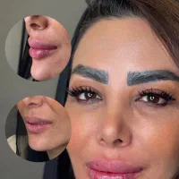 تزریق فیلر و بوتاکس با تخفیف ویژه در کلینیک زیبایی|خدمات آرایشگری و زیبایی|ساری, |دیوار