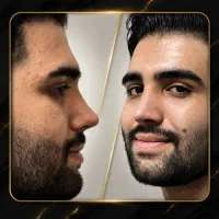 بینی استخوانی40میلیون، گوشتی58میلیون+نقدواقساط|خدمات زیبایی و سلامت|شیراز, ستارخان|دیوار